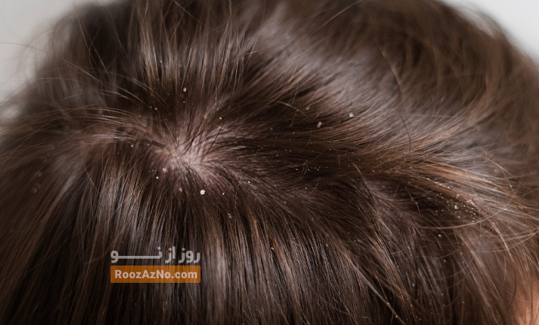 Dandruff