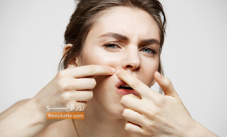 facial acne